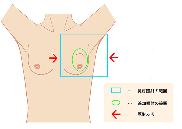 乳房温存療法後の放射線治療について