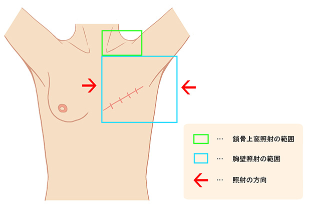 乳房切除後の放射線治療について