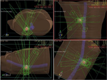 定位放射線の治療例